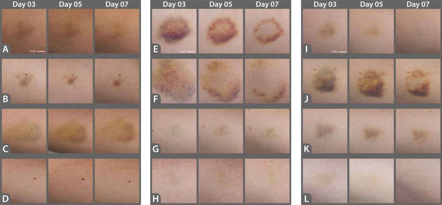 101 Series The Colorful Stages of Skin Bruising Food for Skin